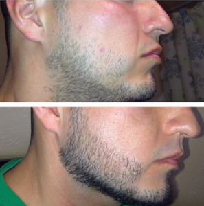 Minoxidil na bradu