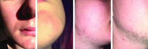 Minoxidil na bradu